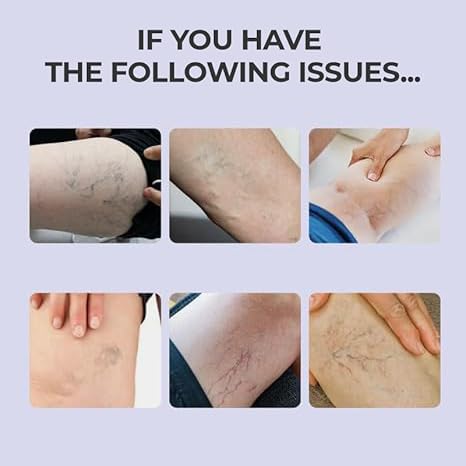 Soothing Leg Cream,Varicose Relief Cream,Cooling Gel For Varicose Veins Tr-eatment For Legs,Naturaly Plant-Based Ingredient 2pcs