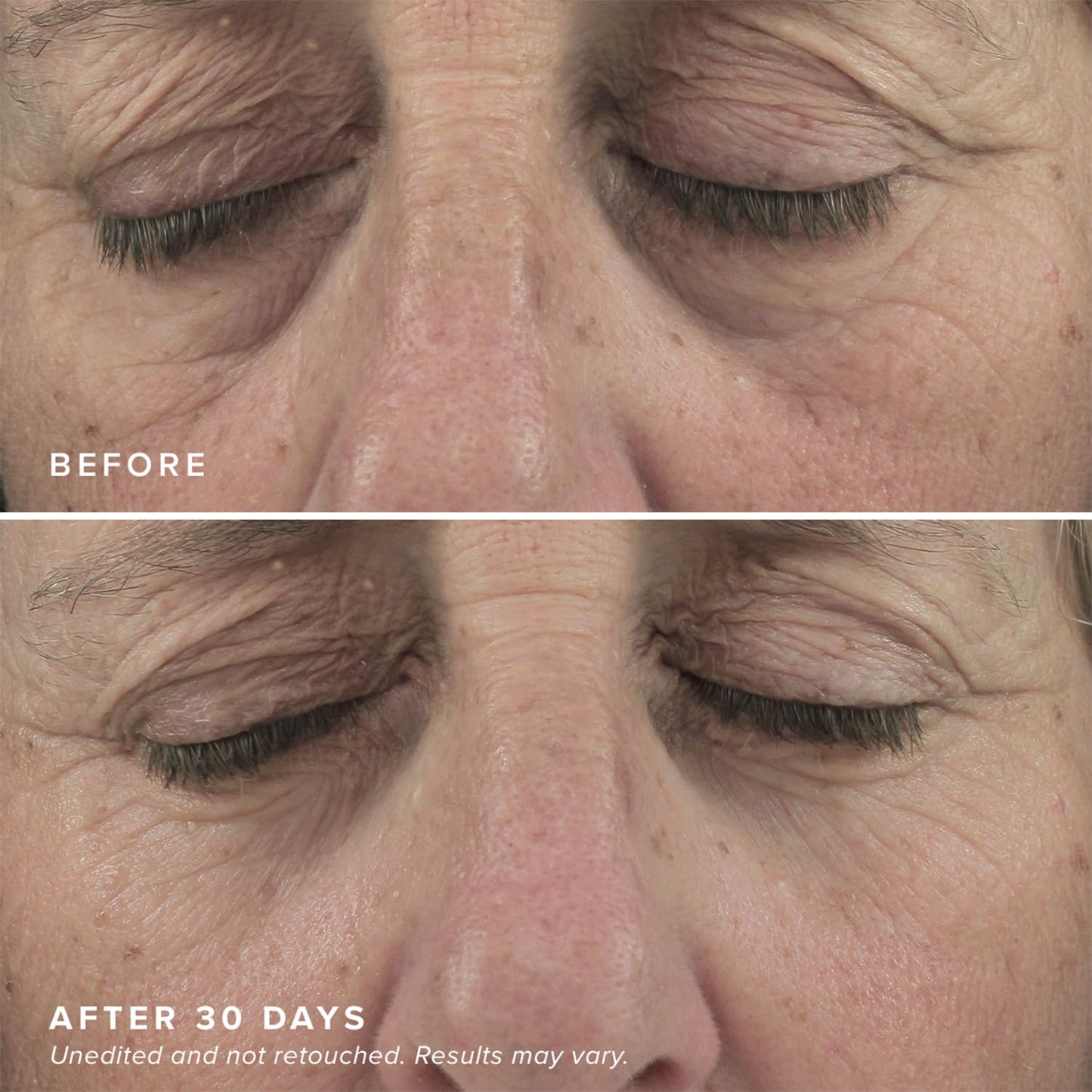 DRMTLGY Brightening Eye Masks (30 Pairs) - Caffeine Eye Masks for Dark Circles and Puffiness with Hyaluronic Acid, Eye Patches for Puffy Eyes - 2 pack