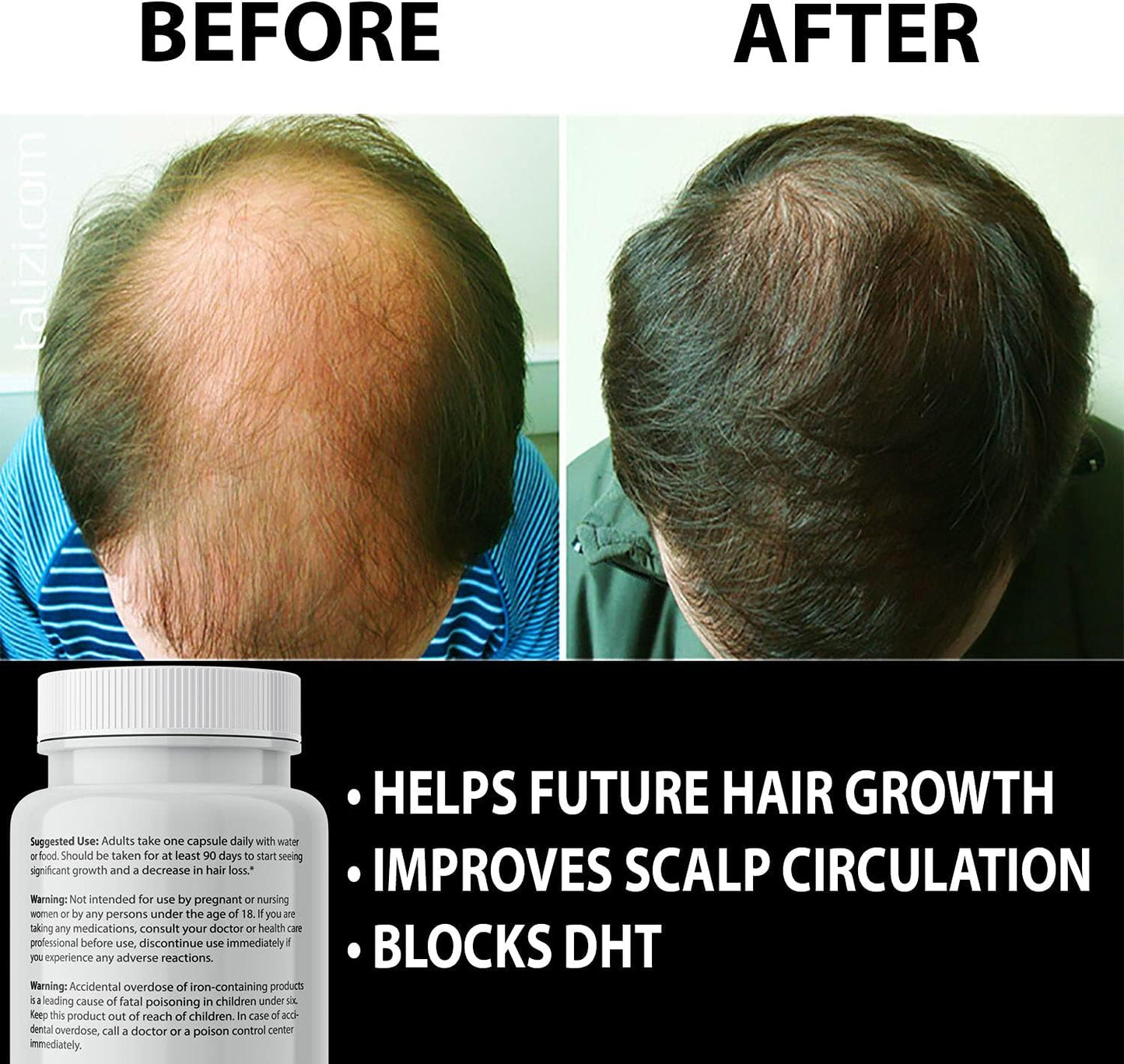 Finanutride Natural DHT Blocker & Hair Growth Capsules - Prevent Hair Loss, Stimulate Follicles, Proprietary Regrowth Treatment
