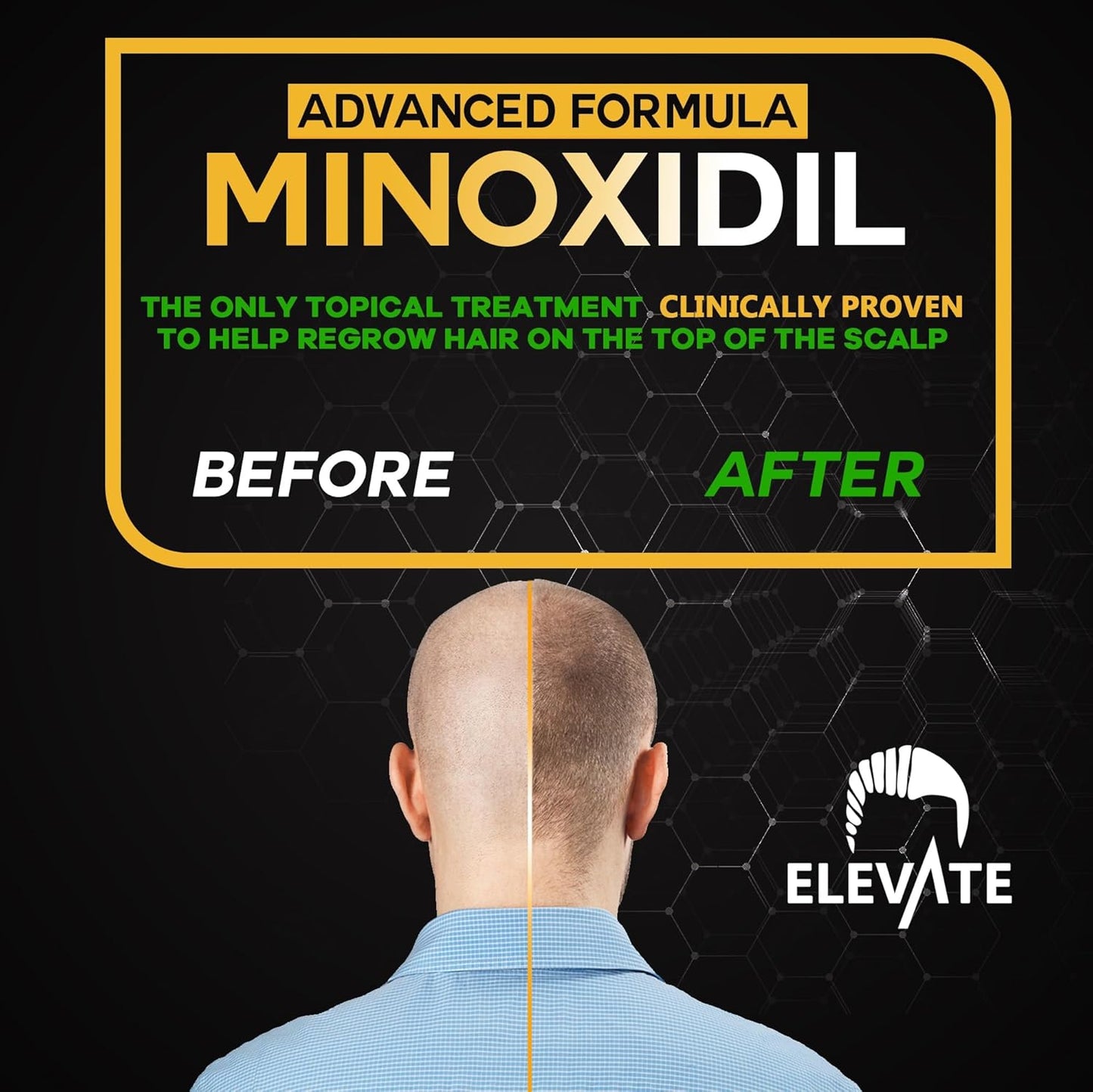 Elevate Hair Regrowth Treatment 5% Minoxidil Spray - Extra Strength Formula Professional Treatment for Hair Loss and Thinning for Regrowth - Stimulate Follicles for Men and Women 1 Month Supply