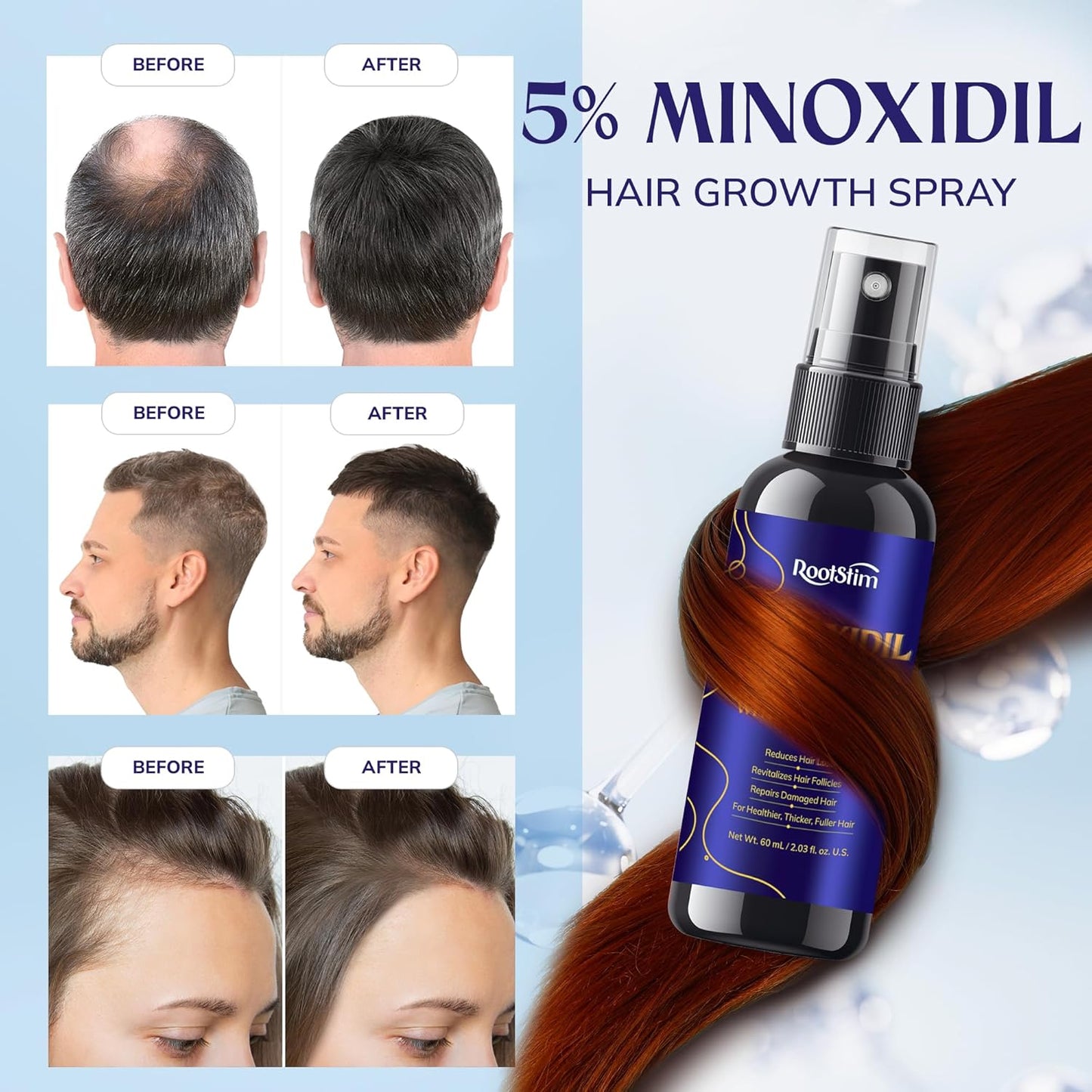 5% Minoxidil Hair Growth for Men and Women: Extra Strength Minoxidil Hair Loss Treatment Serum with Rosemary for Faster Stronger Thicker Hair Growth 60ML