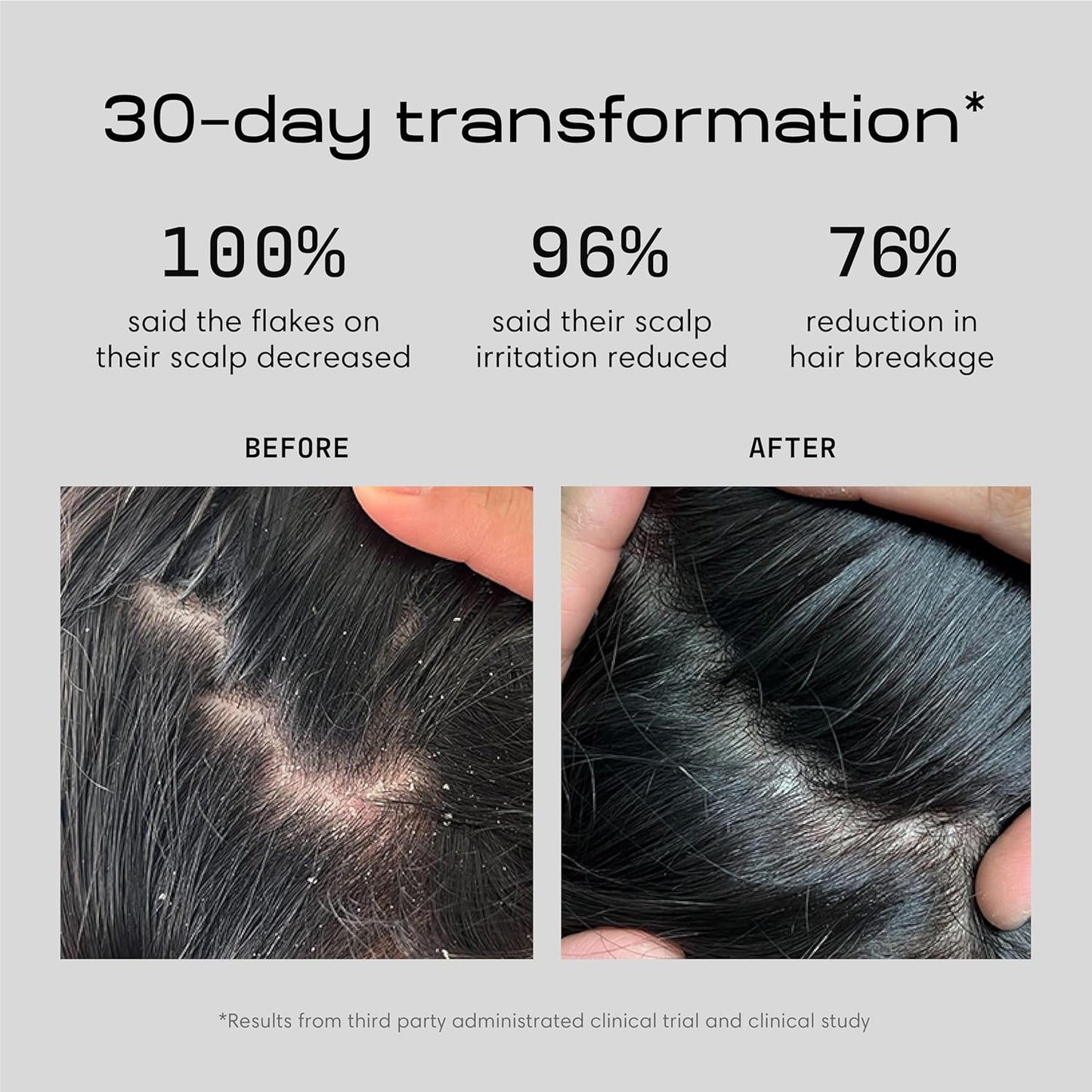 Jupiter Anti Dandruff Shampoo - Shampoo for Men & Women for Flaky, Itchy, Oily, & Dry Scalp - Nourishes Scalp and Reduces Breakage & Flakes - Color-Safe, Sulfate-Free, Paraben-Free