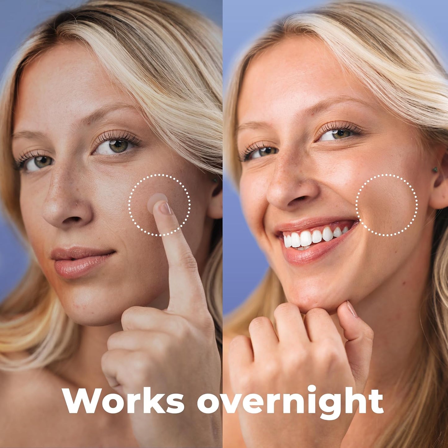 Salicylic Pimple Patches (120 Pack), Salicylic Acid Acne Patches with Tea Tree Oil - Zit Patch and Pimple Stickers for Face for Skin Care - Salicylic Acid Acne Dots (Packaging May Vary)